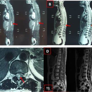 A T1 Weighted Magnetic Resonance Imaging In Sagittal View