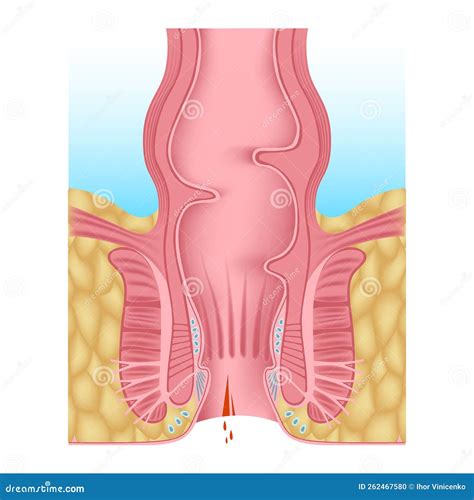 Anal Fissure Hemorrhoids Of The Anal Opening Stock Vector Illustration Of Intestine Cancer