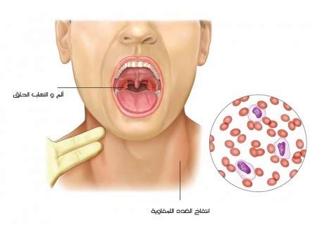 فيروس ايبشتاين بار