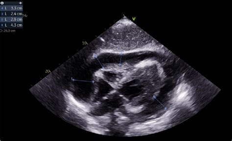 Subcostal Tte View Depicting A Large Pericardial Effusion With