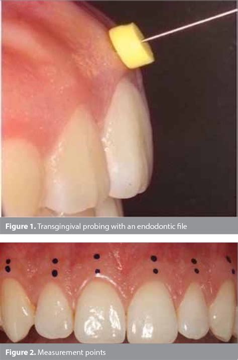 Figure 1 From Assessment Of Gingival Biotype And Keratinized Gingival Width Of Maxillary