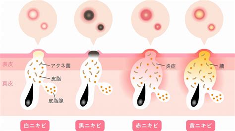 白ニキビ・黒ニキビが出来る原因や治し方｜ニキビは潰しても大丈夫？｜千里皮膚科