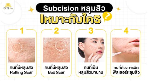 Subcision หลุมสิวคืออะไร ทำดีไหม