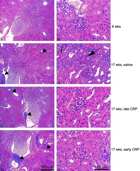 Prevention And Reversal Of Nephritis In Mrl Lpr Mice With A Single