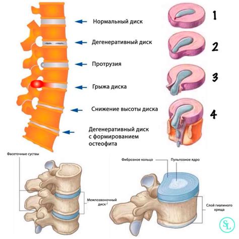 Секвестрированная грыжа диска позвоночника, L4–L5, L5–S1, C5–C6 ...