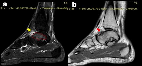 Intra Articular Subperiosteal Osteoid Osteoma Of The Talar Neck