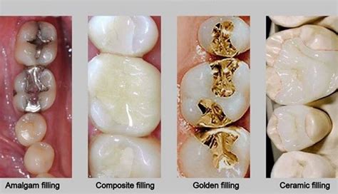 Everything You Need To Know About The Dental Cavity Fillings