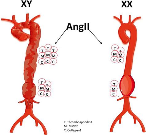 Sex Chromosome Complement Defines Diffuse Versus Focal Angiotensin Iiinduced Aortic Pathology