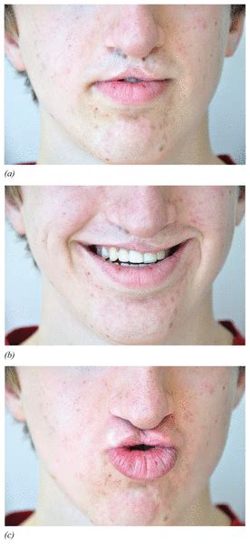 View Of Assessing The Effectiveness Of Massage Therapy For Bilateral Cleft Lip Reconstruction