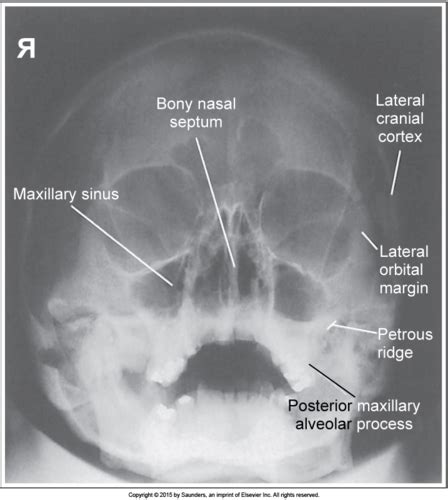 Nasal Bone X Ray Anatomy