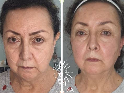 Antes Y Despu S De Rejuvenecimiento Facial Huaika