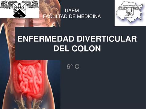 Ppt Enfermedad Diverticular Del Colon Powerpoint Presentation Free