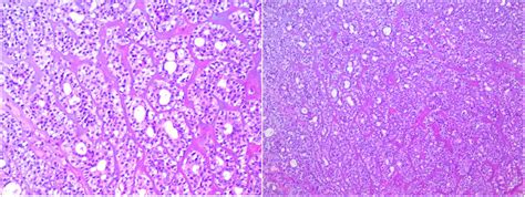 Epithelialmyoepithelial Carcinoma Originating From Minor Salivary