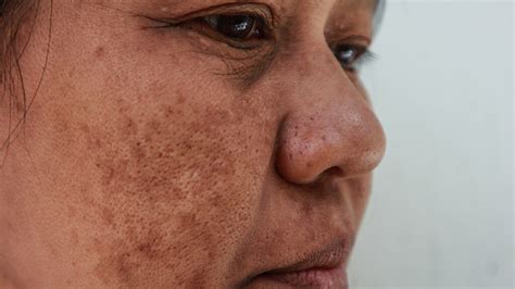 Melasma Causes Symptoms Pictures Treatment