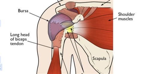 Shoulder Pain Rotator Cuff Tear Vs Rotator Cuff Tendinitis Opinion