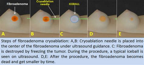 Symptoms of Fibroadenoma « MedicineBTG.com