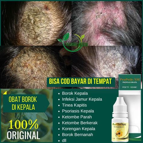 Jual Obat Borok Kepala Infeksi Jamur Kulit Kepala Tinea Capitis