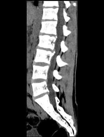 Limbus fracture | Radiology Case | Radiopaedia.org