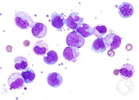 Pheresis Collection Post G Csf Therapy 2