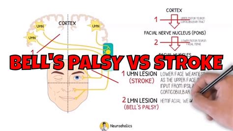 Bell S Palsy Vs Stroke Bell S Palsy All You Need To Know Elevate