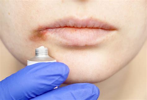 Cu L Es El Mejor Tratamiento Para El Herpes Labial Tendenzias