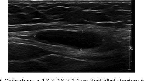 Figure 1 From Canal Of Nuck Hydrocele In An Adult Female Semantic Scholar