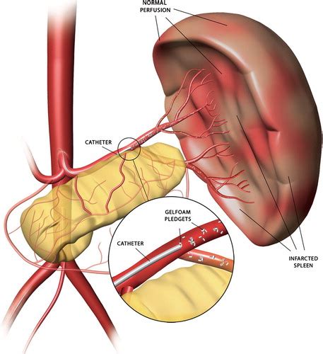 SAE (SPLENIC ARTERY EMBOLISATION) – Interventional radiology