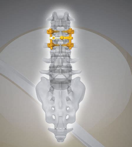 Sistema De Osteos Ntesis Lumbar Nex D Next Orthosurgical V A