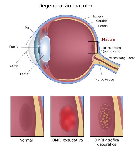 Degeneração macular - tipos, causas, tratamento - InfoEscola