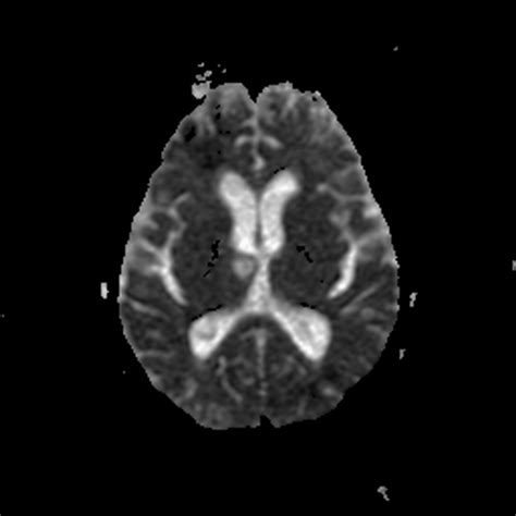 Neurocysticercosis Before And After Treatment Image Radiopaedia Org