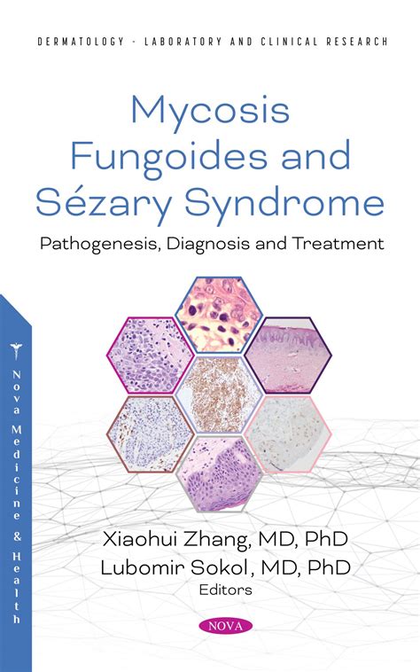 Mycosis Fungoides and Sézary Syndrome Pathogenesis Diagnosis and