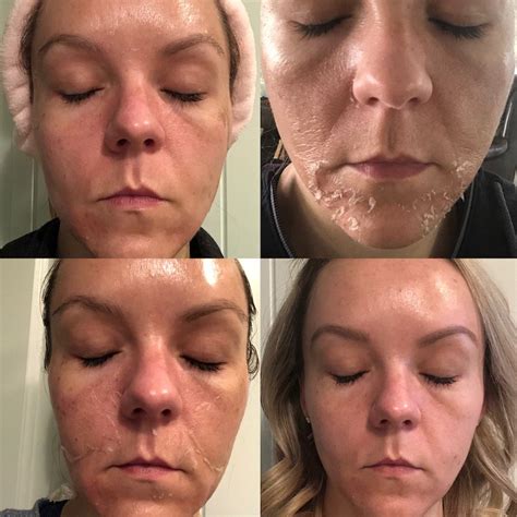 TCA Peel Usage Cost And Results 41 OFF