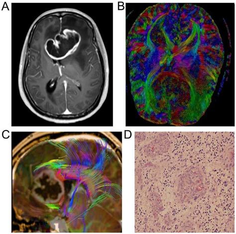 Male 58 Years Old With Bilateral Frontal Lobe Spongioblastoma Who