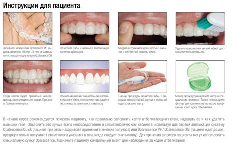 Opalescence система домашнего отбеливания | Отзывы и ответы на самые ...