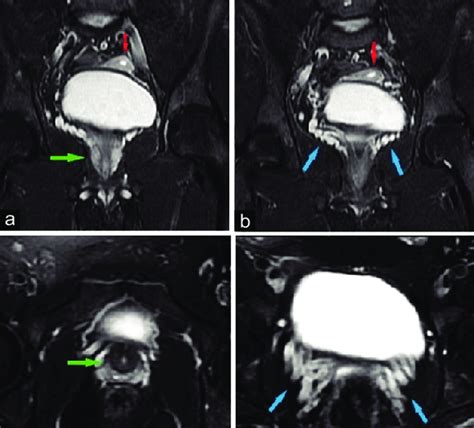 A Year Old Individual With Ovotesticular Disorder Of Sex Development