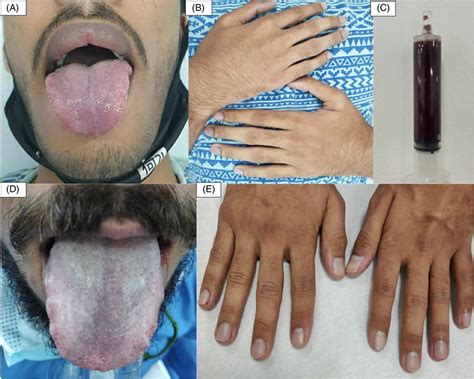 Cyanosis Definition Causes Symptoms Diagnosis And Treatment