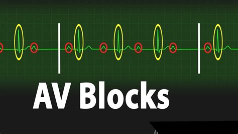 Atrioventricular Block Av Block Types Of Heart Block Part 2