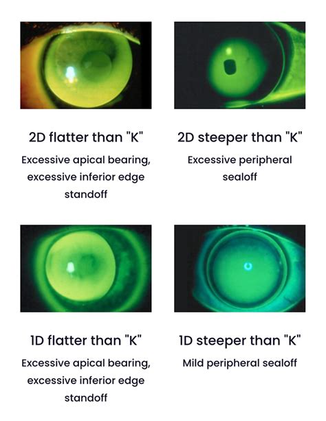 Spherical GP Lens Tools And Resources GPLI