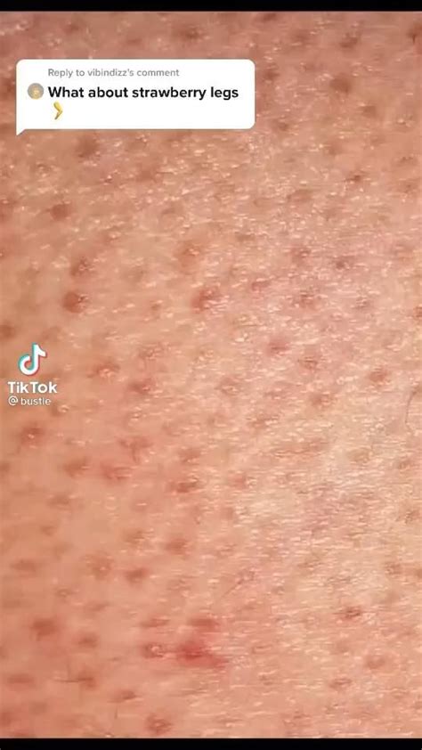 Get Rid Of Bikini Bumps Quick Artofit