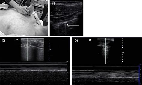 Ultrasound Focused Assessment With Sonography For Trauma Fast Exam