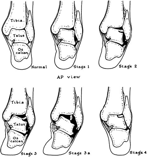 Osteochondritis Dissecans Of The Talus Clinics In Sports Medicine