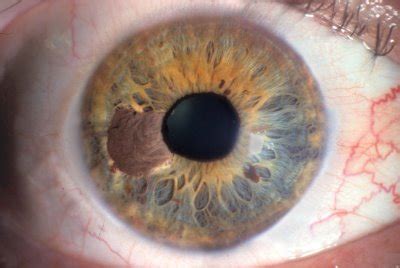 symptoms  eye cancer cancer research