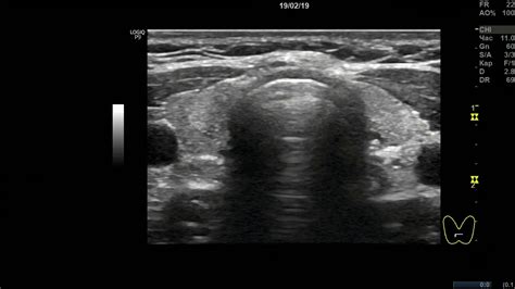 Клинический случай 9. (УЗИ Щитовидной Железы ) доктор А.В. Ушаков - YouTube