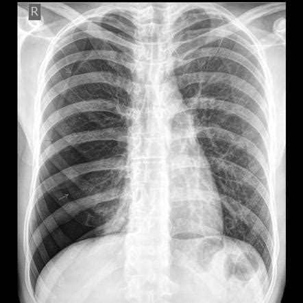 pneumothorax radiology reference article radiopaediaorg