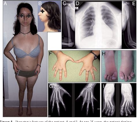 Figure From A Novel Mutation In Thra Gene Associated With An Atypical