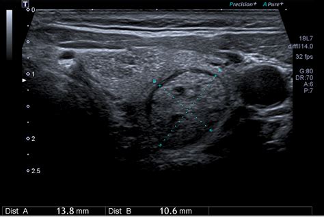 Classification Eu Tirads Toulouse Thyroide