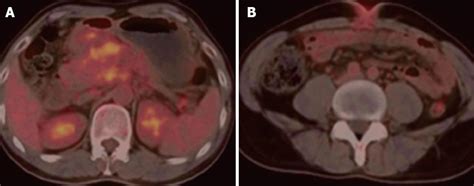 Sister Mary Joseph’s nodule as a first sign of pancreatic cancer
