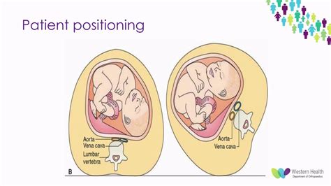 Orthopaedic Trauma In Pregnant Patients By Dr Adrian Talia Youtube