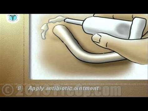 Suprapubic Catheter Change Procedure