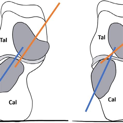 Frontal View Of Right Foot At Calcaneo Cuboid And Talo Navicular Joint